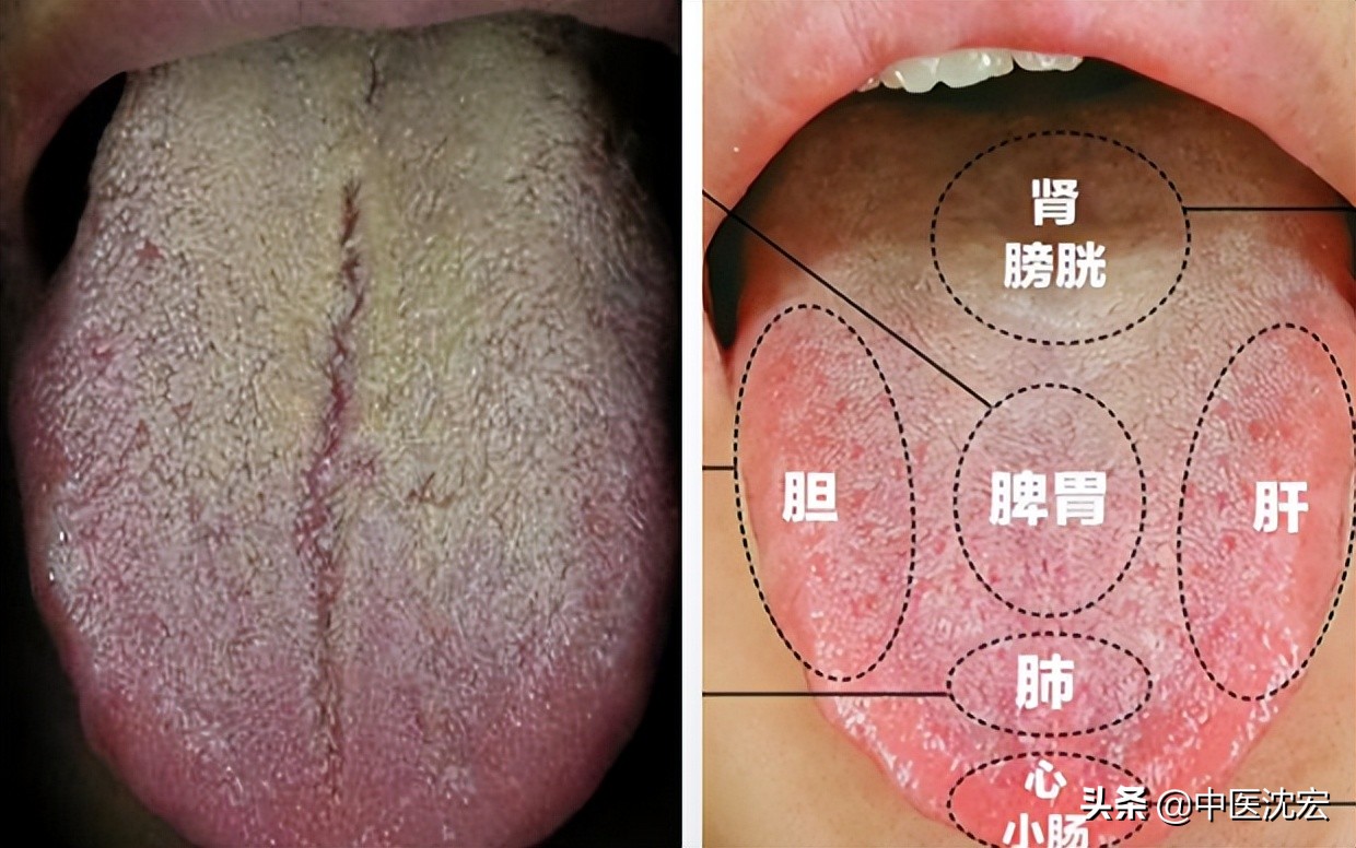 喉咙老有痰健脾祛湿化痰的中成药,喉咙痰多中医怎么祛痰