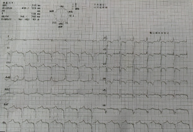 心衰患者icd植入后会加重心衰吗,43岁心衰患者植入人工心脏
