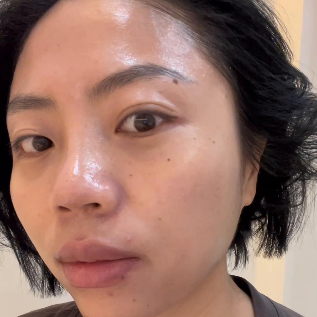 感觉目前很焦虑,做完鼻子19天为何山根看起来很宽