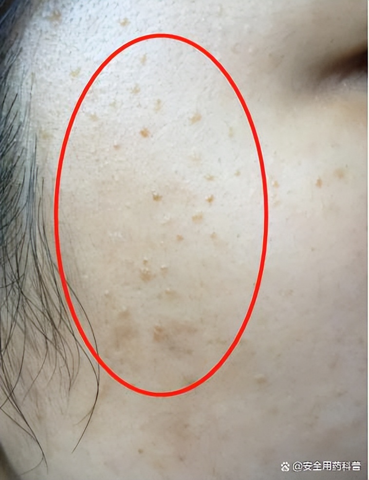 身上的四种疣,身上有很多种疣怎么治疗