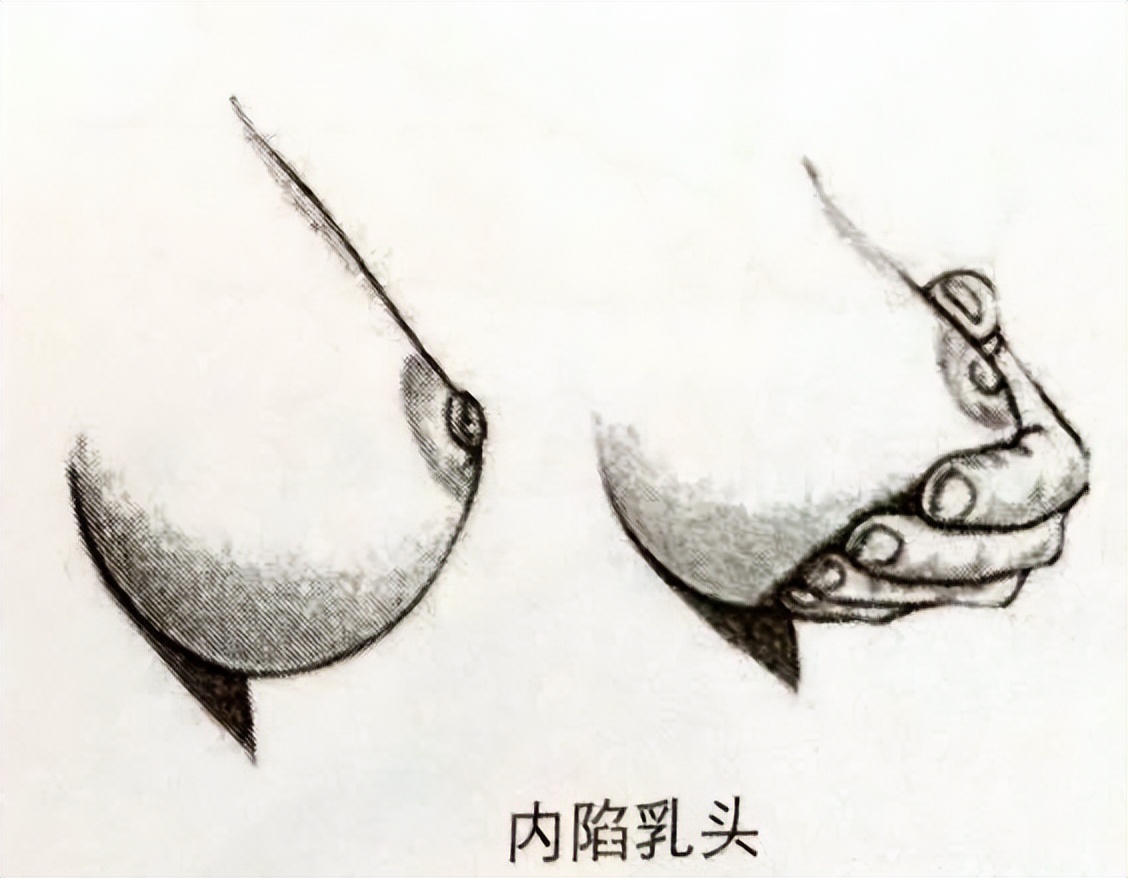 哺乳期乳晕内有个疙瘩是乳腺癌吗,乳圈周围有小疙瘩是乳腺癌吗