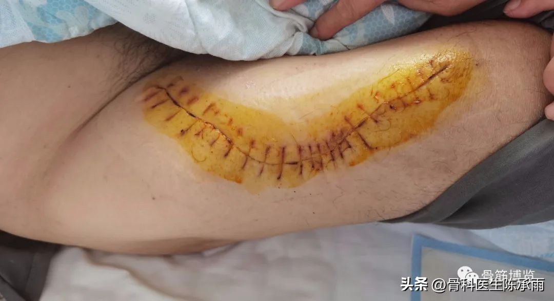 娓哥鐨摚淇,涔旀皬鐨摚淇瓒宠儗澶栦晶鐨偆缂烘崯