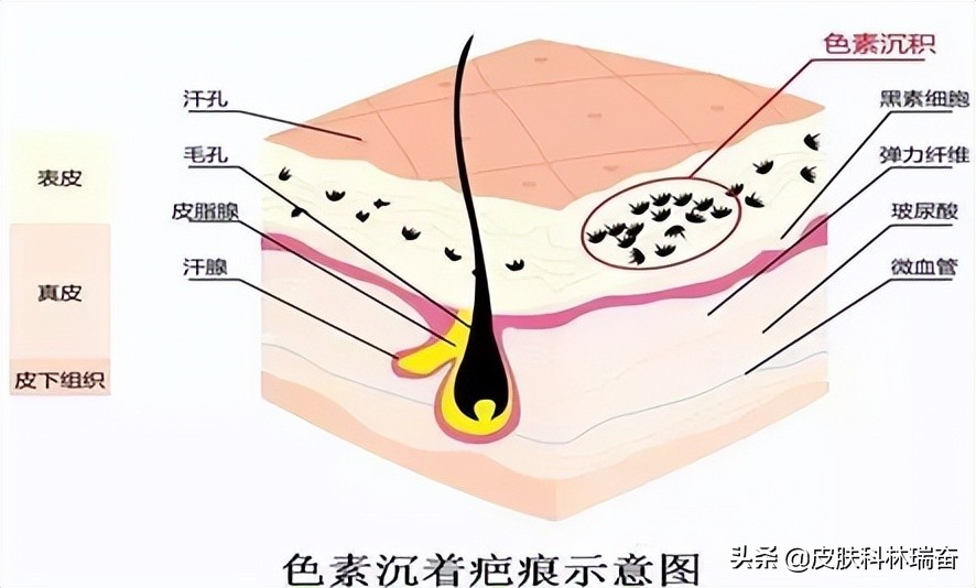 酱油影响疤痕愈合颜色吗,酱油是否会使皮肤留疤