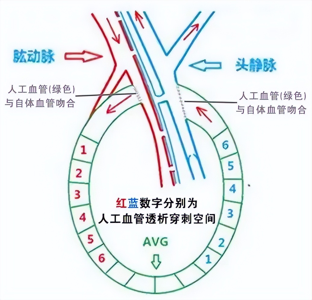 血管造瘘透析,血管人工搭桥