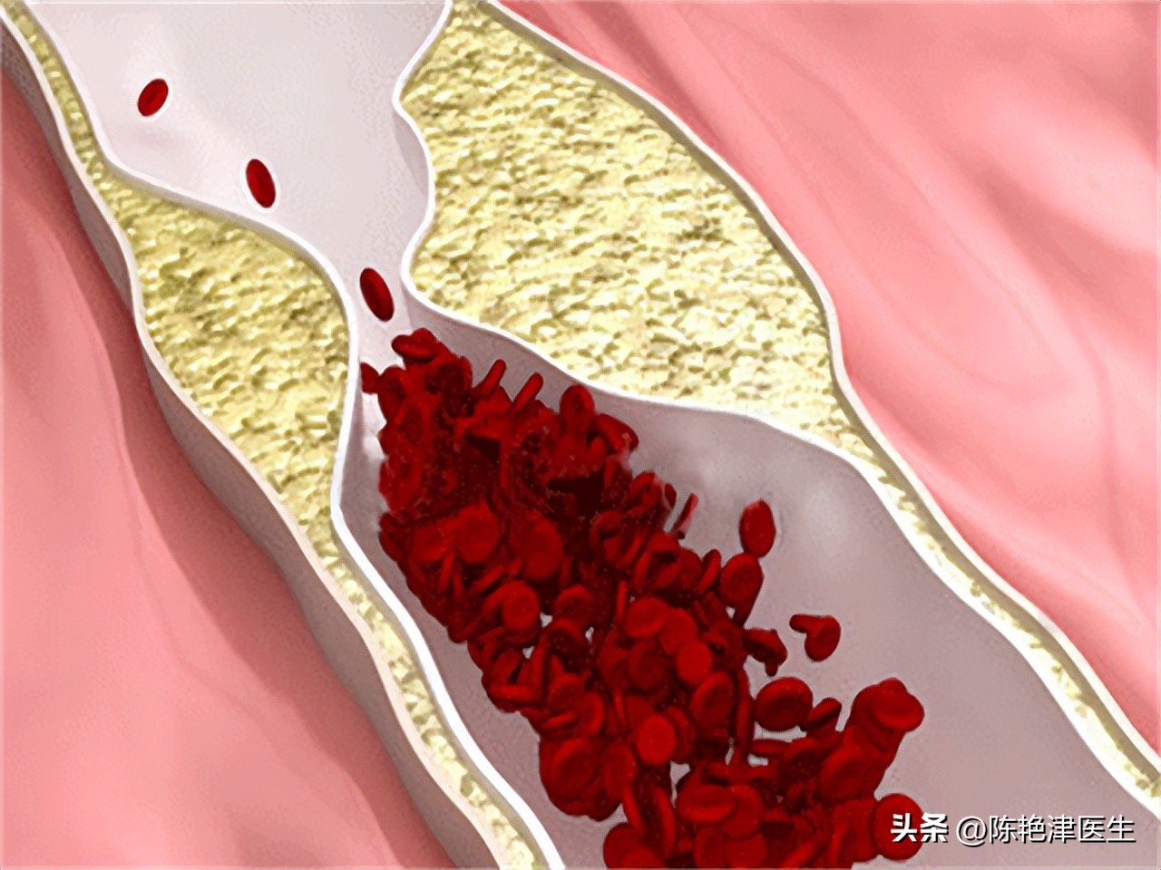 血脂高到什么程度要服用降脂药,血脂高多少需要吃降脂药