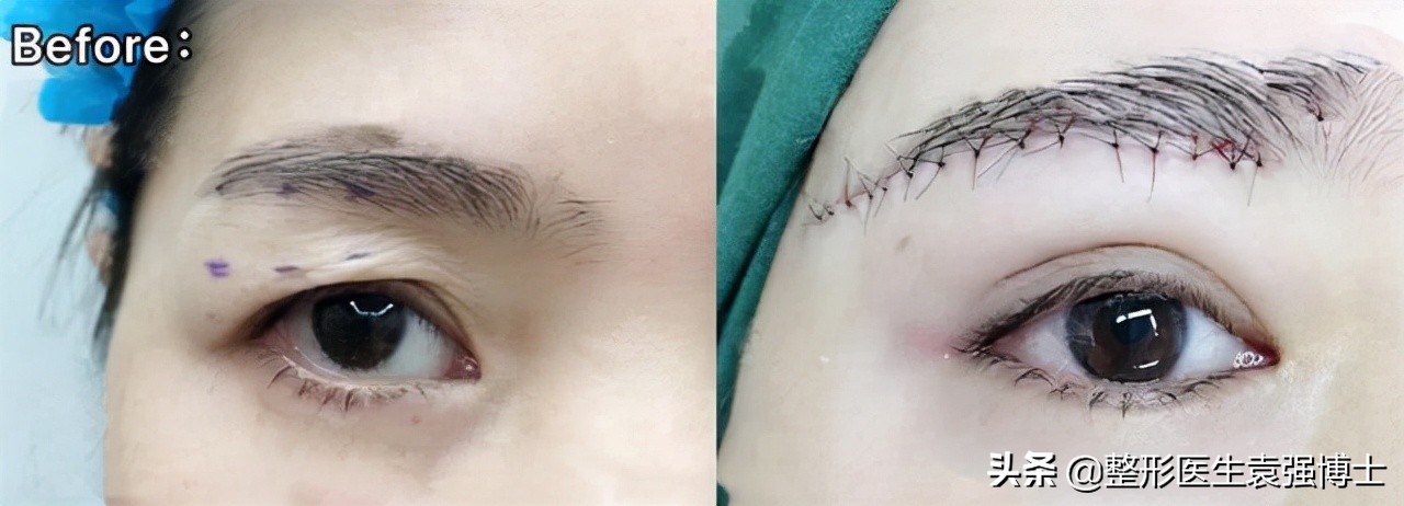 做完提眉和眼袋该注意些什么,做完提眉出现褶皱