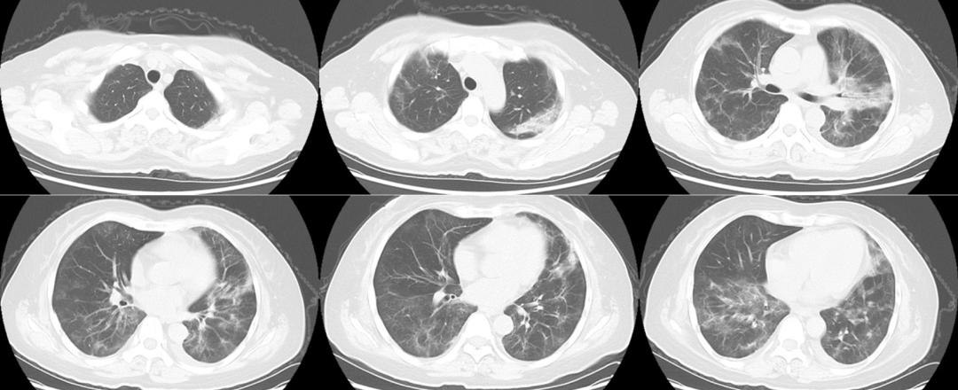 新冠感染第5天病情一直反复,新冠感染后病情历程