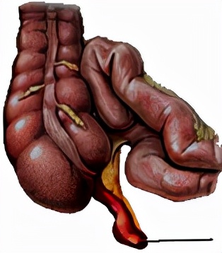 怀孕早期发现有阑尾炎怎么办,怀孕得阑尾炎怎么办胎儿能要吗