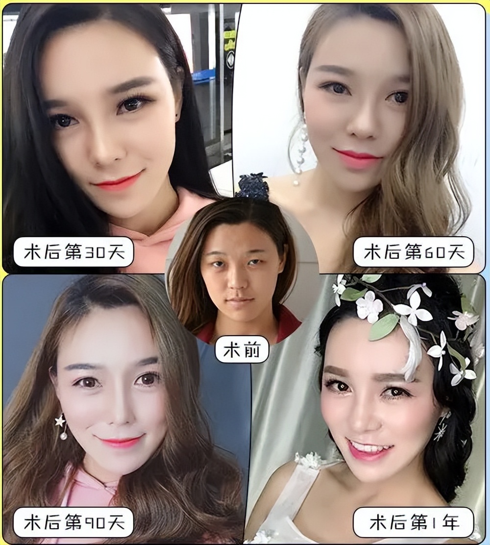 面部填充失败案例,脂肪填充面部失败案例