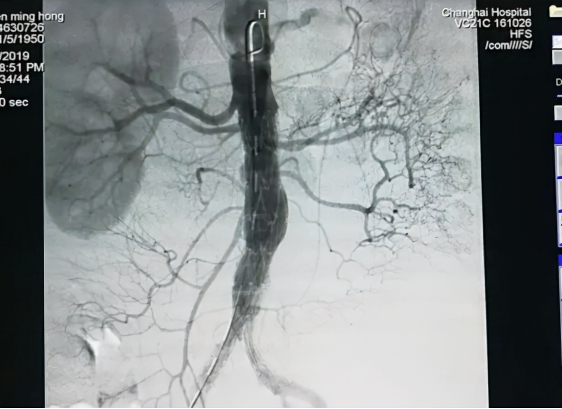 国产降压新药阿利沙坦酯,降压药阿利沙坦酯片的副作用