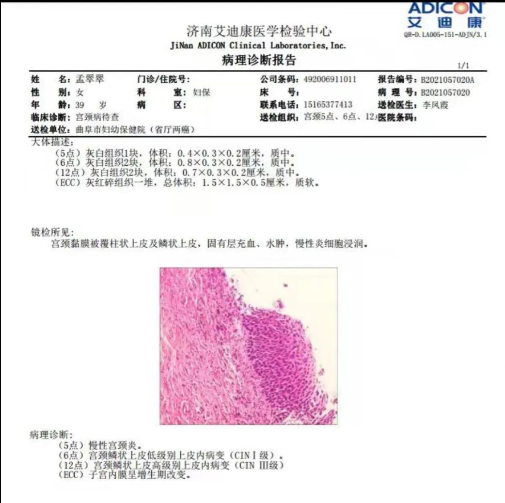 得了HPV发病期多久,我的hpv心路历程
