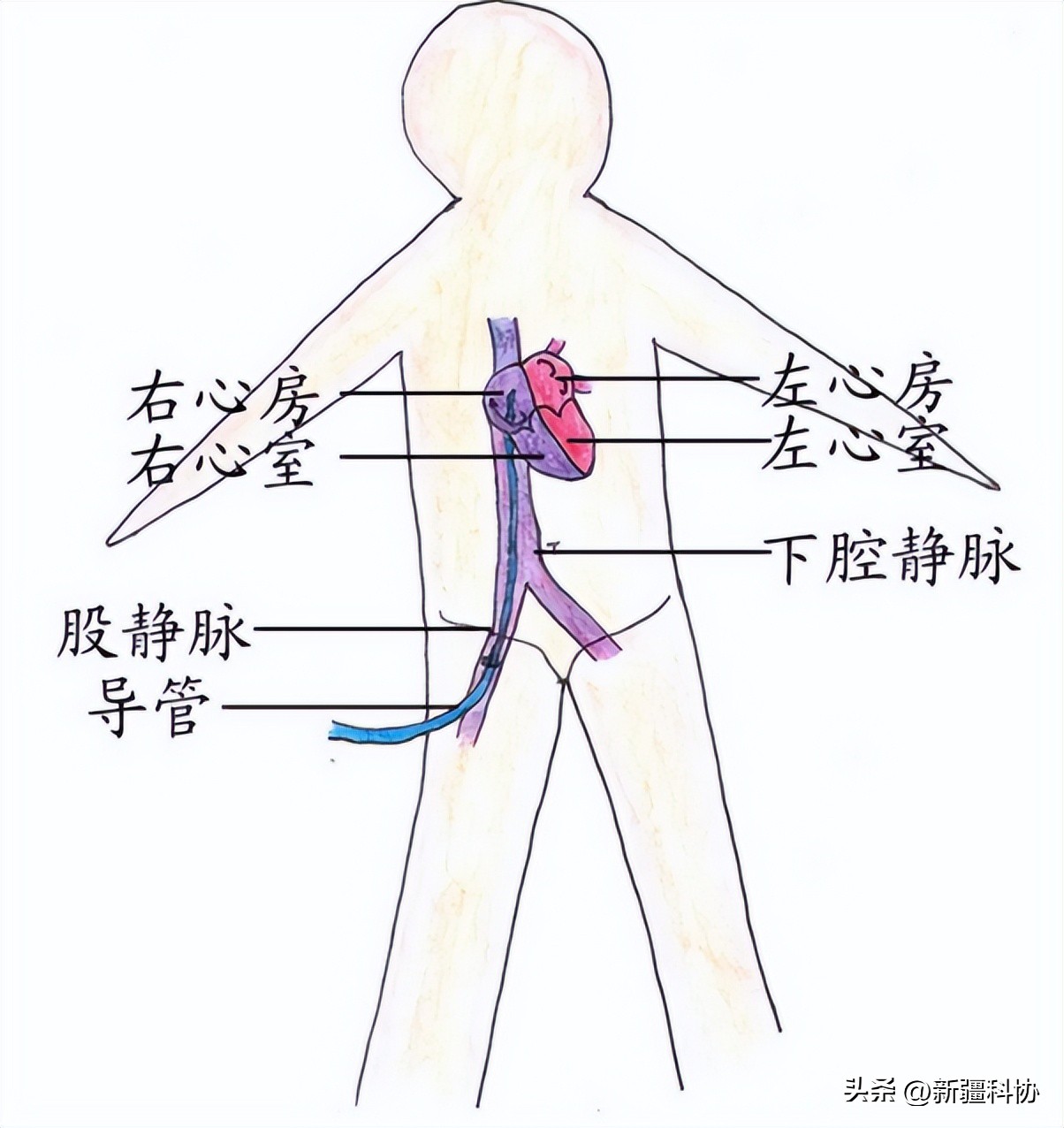 心律失常一定要采用射频消融吗,心律失常射频消融术哪里做得好