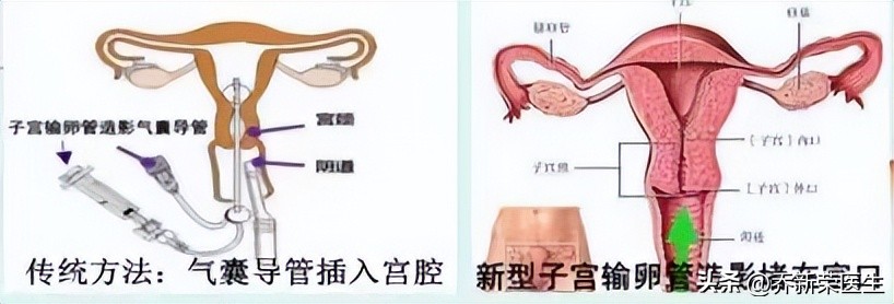 做心脏造影之前要抽血么,做卵巢造影之前需要抽血吗