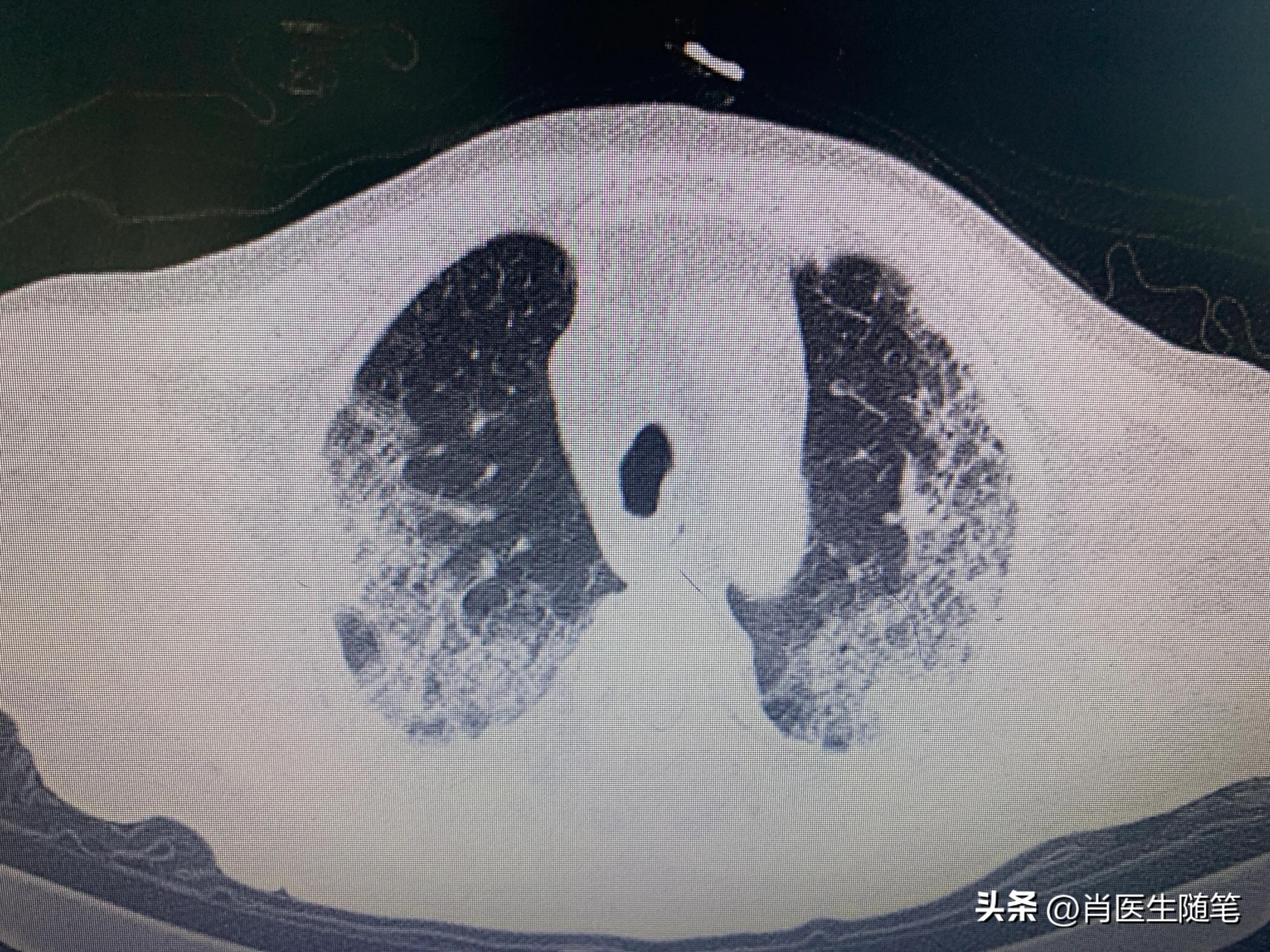 84岁老人白肺治好了,86岁老人得了大白肺还有救吗