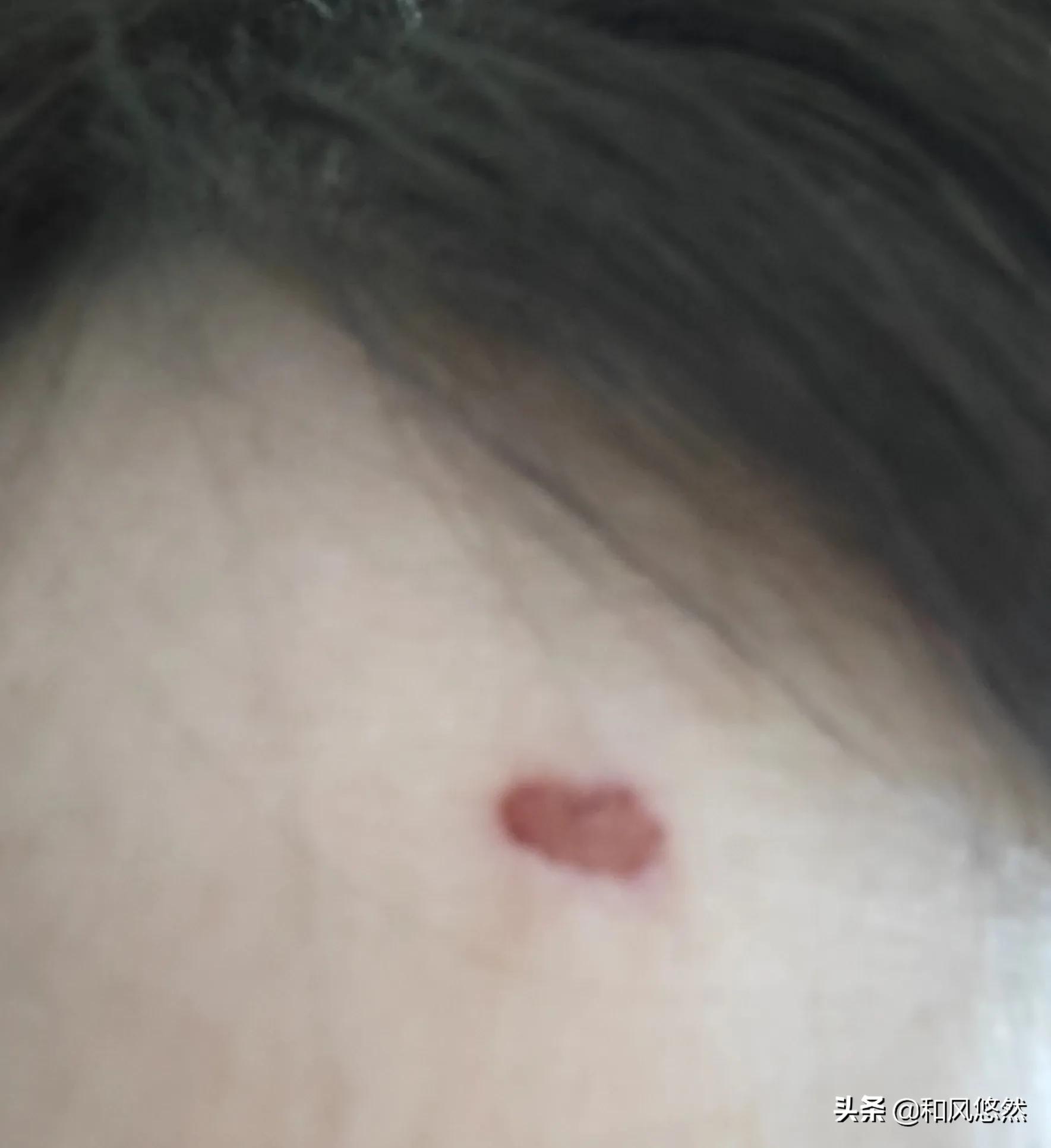 祛斑真实有效推荐,快速祛斑易出现哪些副作用