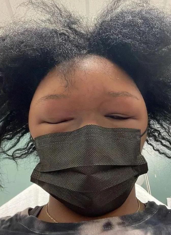 美国妹子染头发过敏全脸肿成emoji，不光失明还险些窒息