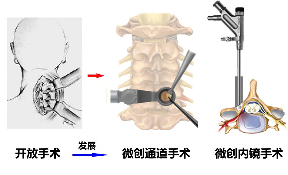 颈椎什么情况可以做微创手术,颈椎什么情况可做微创手术