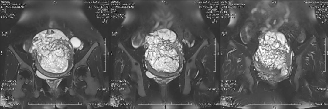 这么典型的葡萄胎MRI影像，快来学习吧