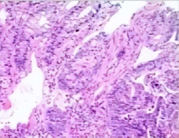 多原发癌症转移,多原发直肠癌