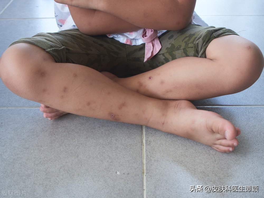 丘疹性荨麻疹和丘疹性皮炎的区别,皮肤科医生丘疹性荨麻疹