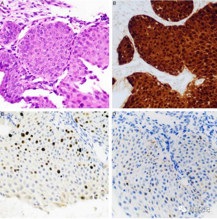 宫颈病理免疫组化p16是什么意思,p16阳性低度上皮病变严重吗