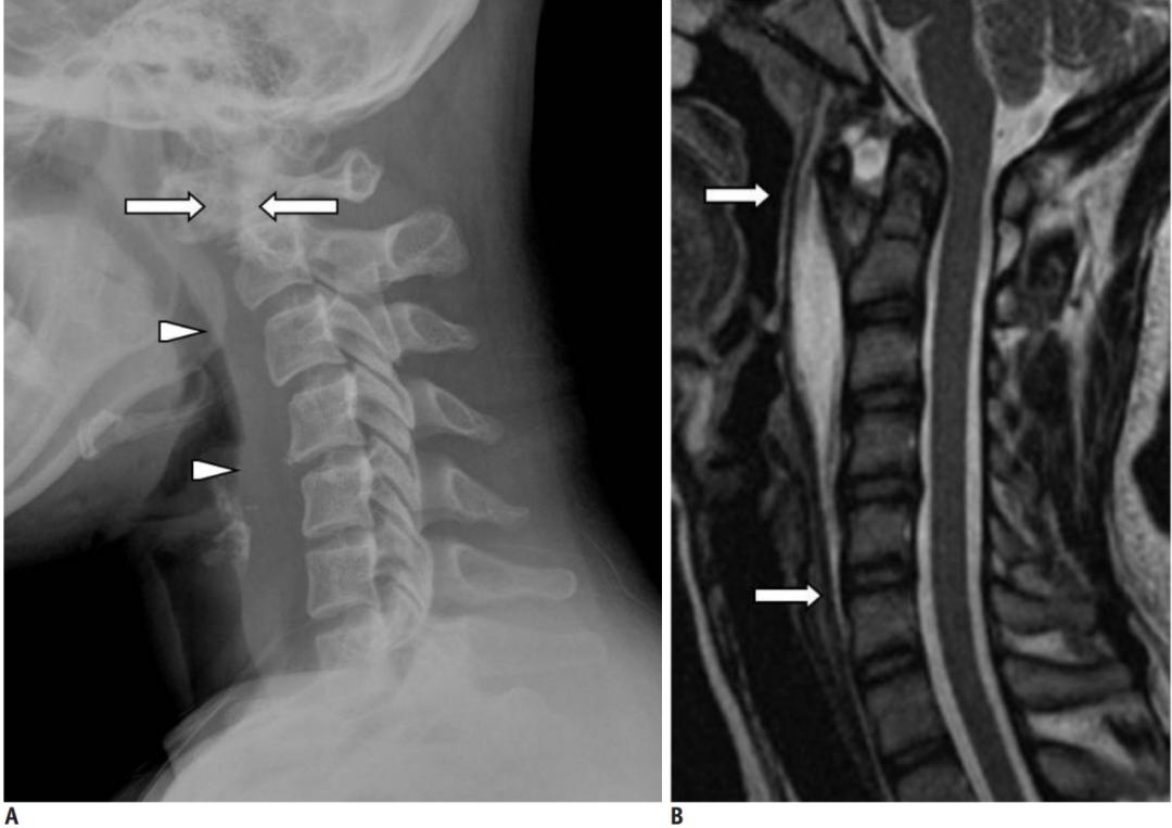 颈长肌腱炎影像表现,三头肌钙化性肌腱炎治疗