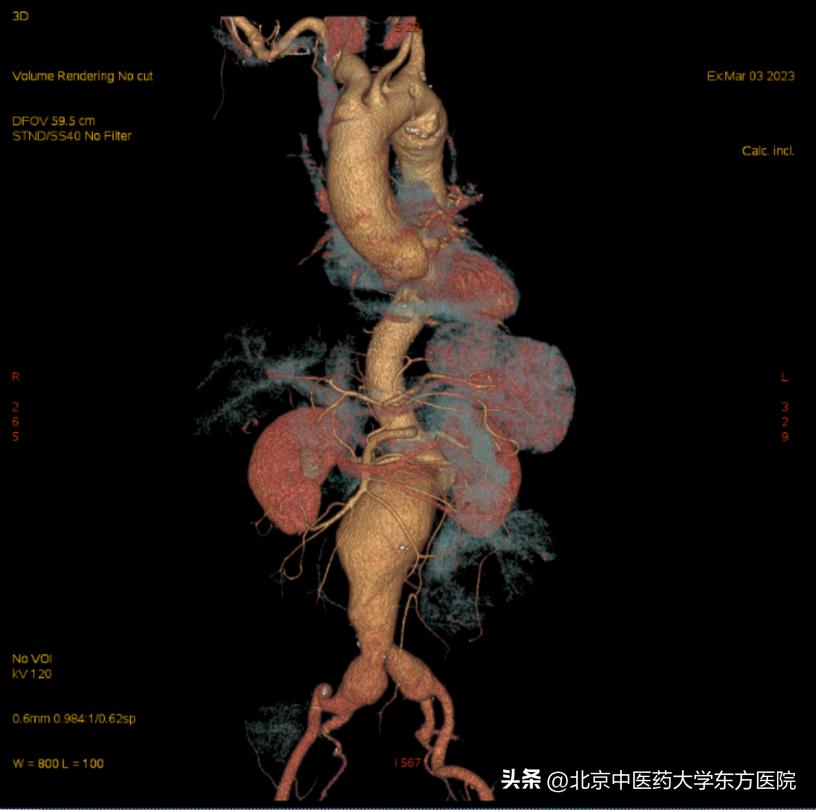 北京中医药大学东方医院成功完成首例保留双侧髂内动脉的巨大腹主动脉瘤合并双侧髂动脉瘤腔内隔绝术！
