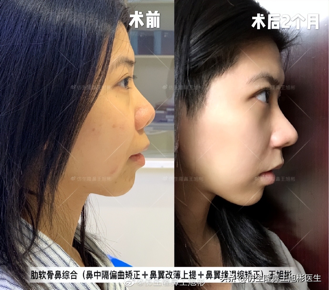 做一次鼻头缩小要多少钱好,可以只做鼻头缩鼻翼吗