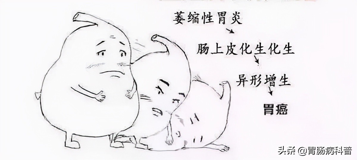 萎缩性胃炎伴肠化增生还能活多久,萎缩性胃炎肠化一定会发展增生吗