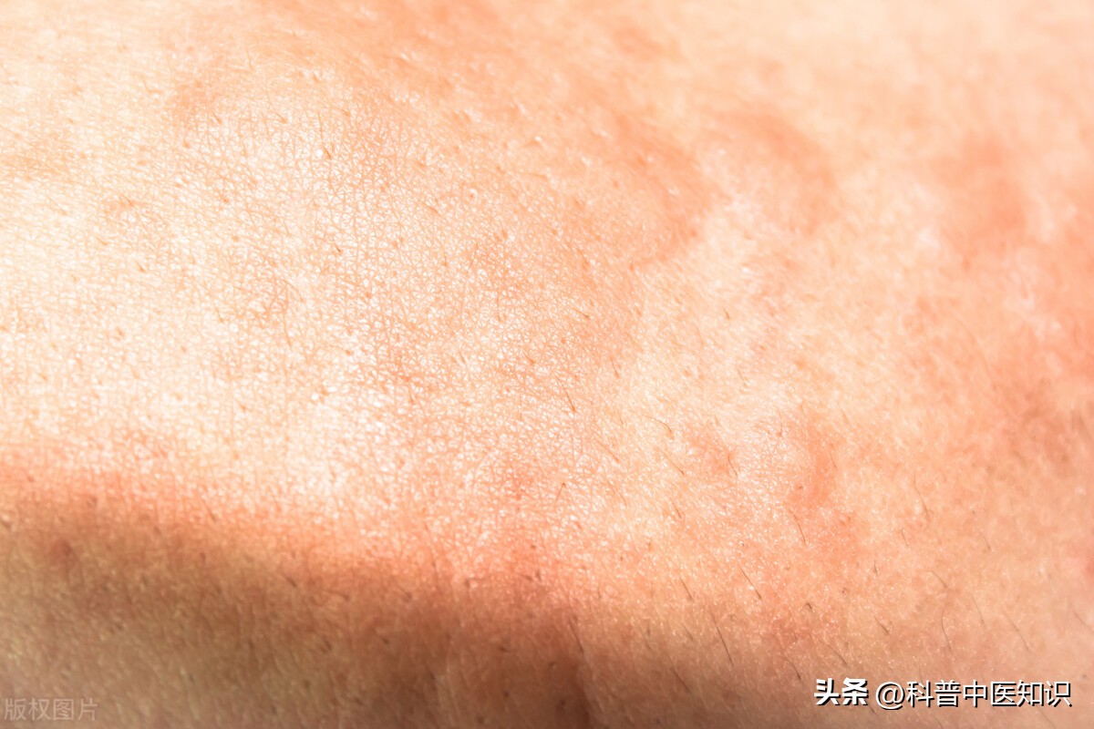 中医治疗荨麻疹医案,中医风邪引起的荨麻疹怎么治