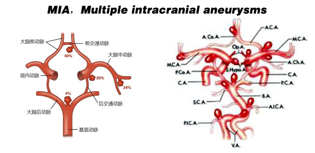 检查脑子里有瘤,检查出动脉瘤需要怎么处理