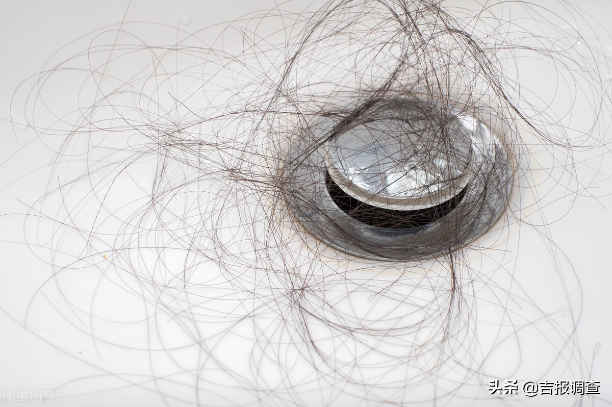 脱发严重自然卷发际线高,脂溢性脱发即雄激素性脱发