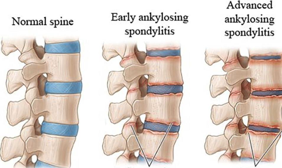 治疗强直性脊柱炎必须按体质治吗,针对强直性脊柱炎最好的锻炼方法