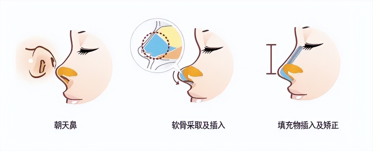 上海九院韦敏轮廓做得好吗,上海九院韦敏鼻子做得好吗