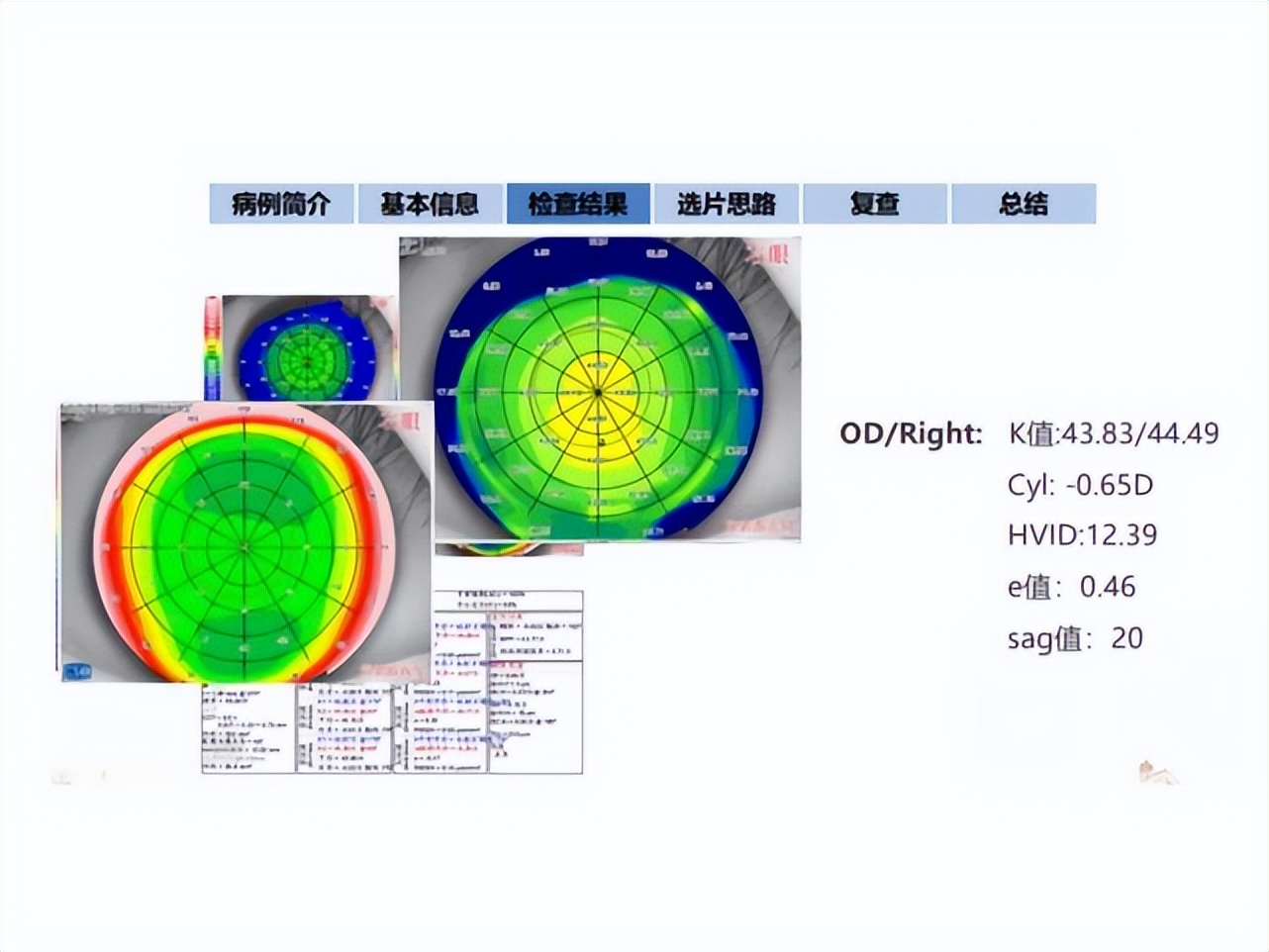 王凯角膜塑形镜原理,王凯医生塑形镜