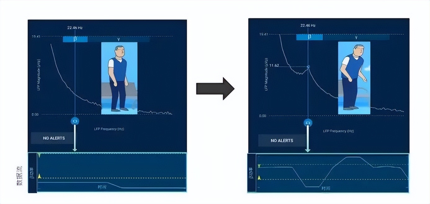 智能可感知脑起搏器植入手术,山西省首例机器人植入脑起搏器