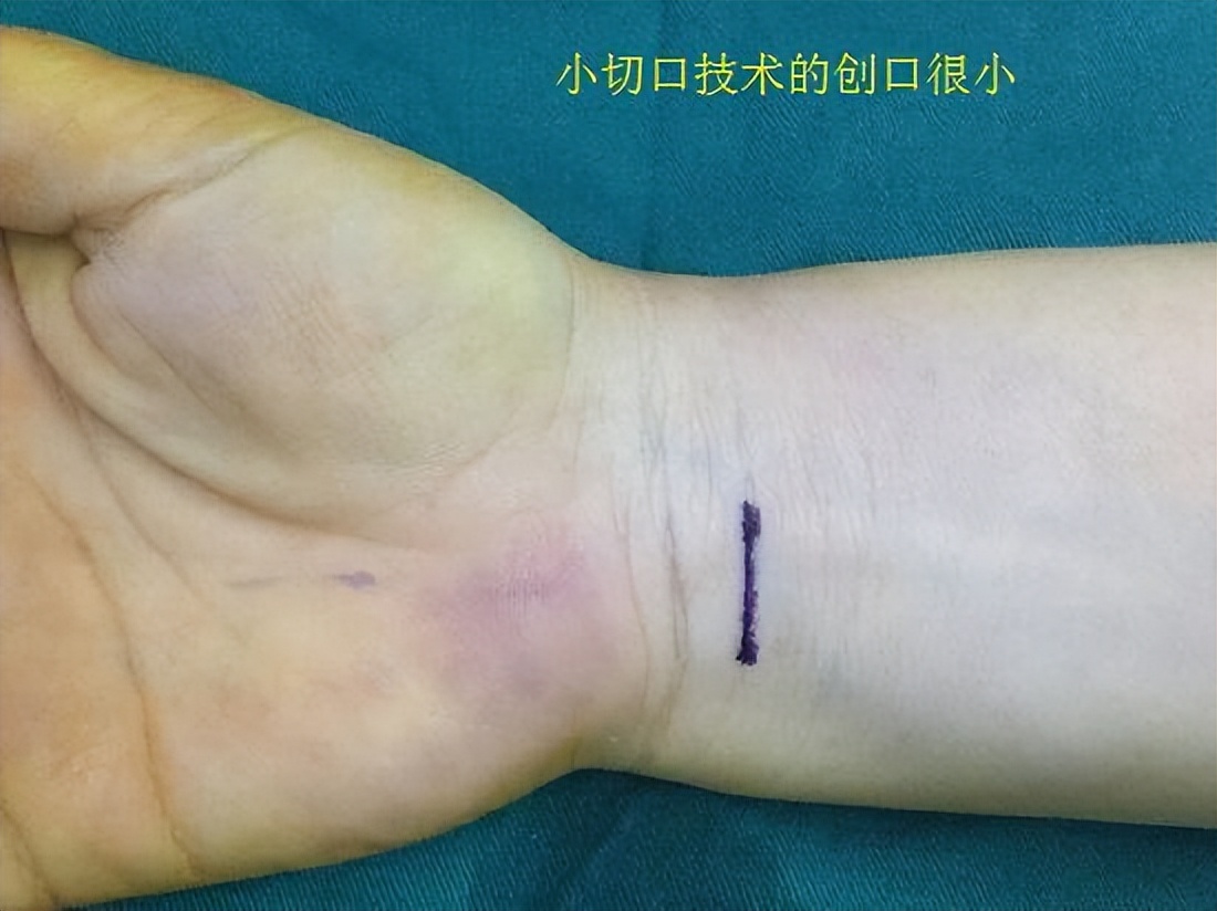 手部麻木怎么办,手部麻木吃什么药好