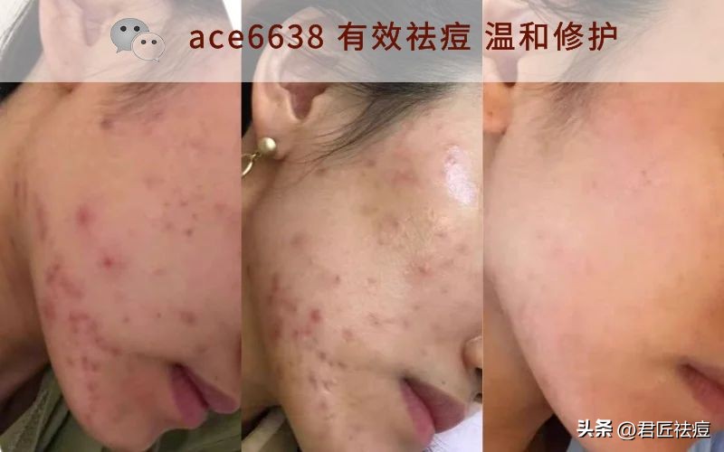 油皮痘肌怎么控油,油皮痘痘肌怎么内调