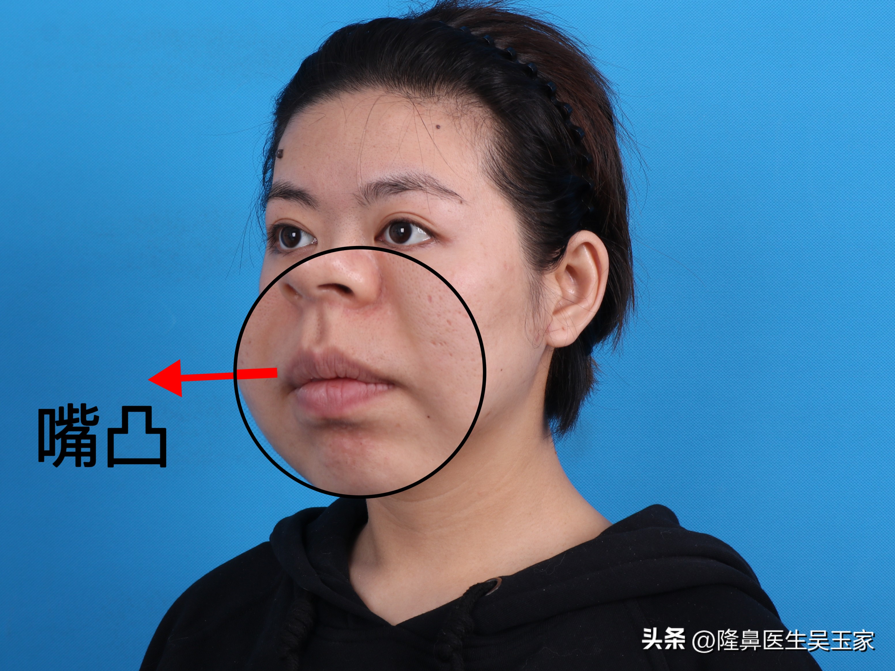 35岁去法令纹用哪个产品,去鼻纹最好的方法是什么