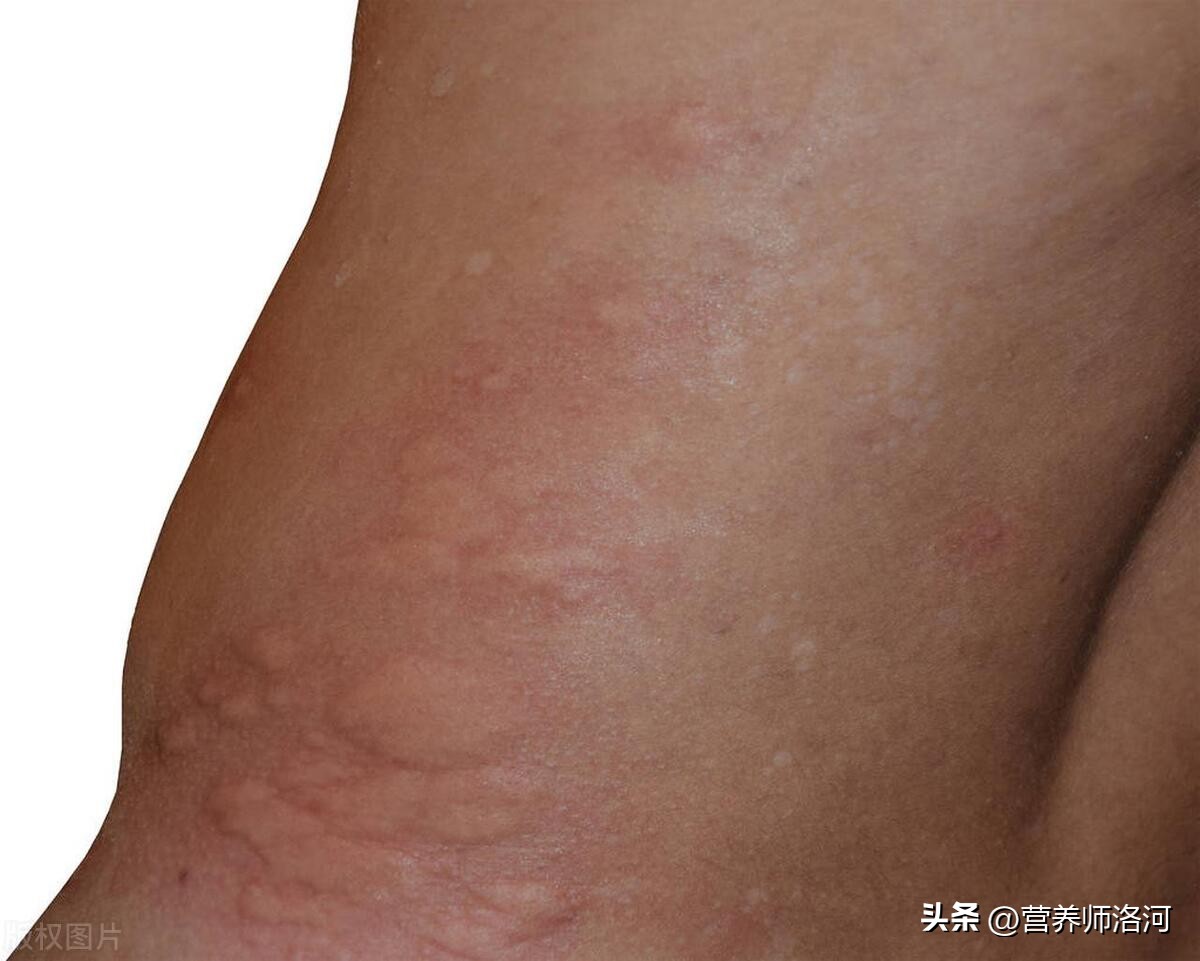 食物过敏吃什么食物好,皮肤过敏吃什么食物最好