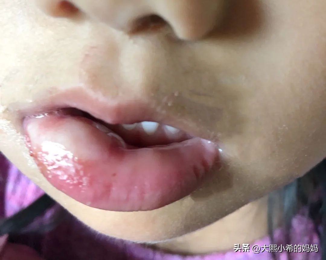 孩子洗牙补牙,儿童蛀牙洗牙要多少钱