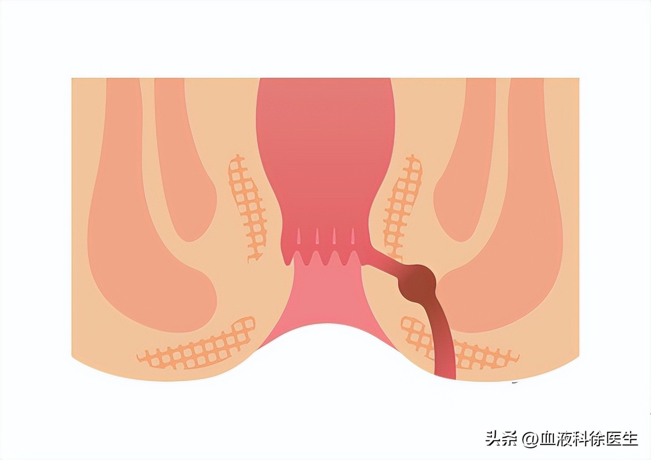 肛瘘手术真的有那么痛苦嘛,肛瘘手术在所有手术中的痛苦排名