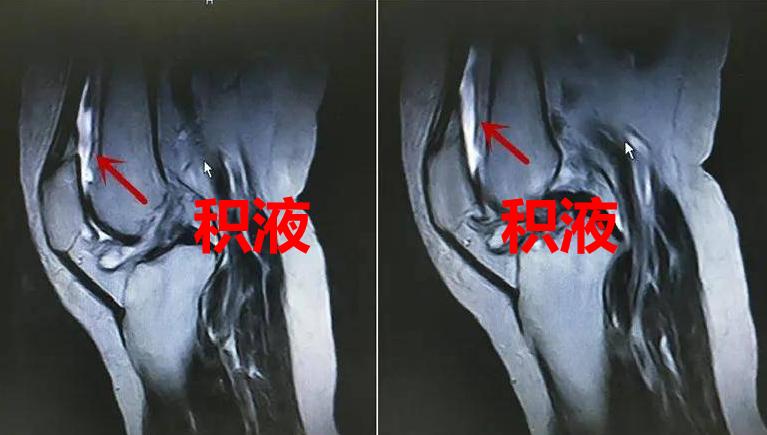 张仲景治疗膝盖冰冷的方子,消水散治疗膝盖积液