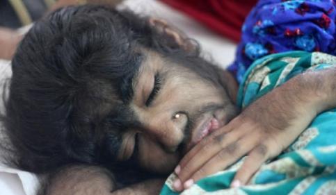 故事:非洲17岁女孩长满络腮胡,毛发从鼻孔长到脖子,身体有何异常