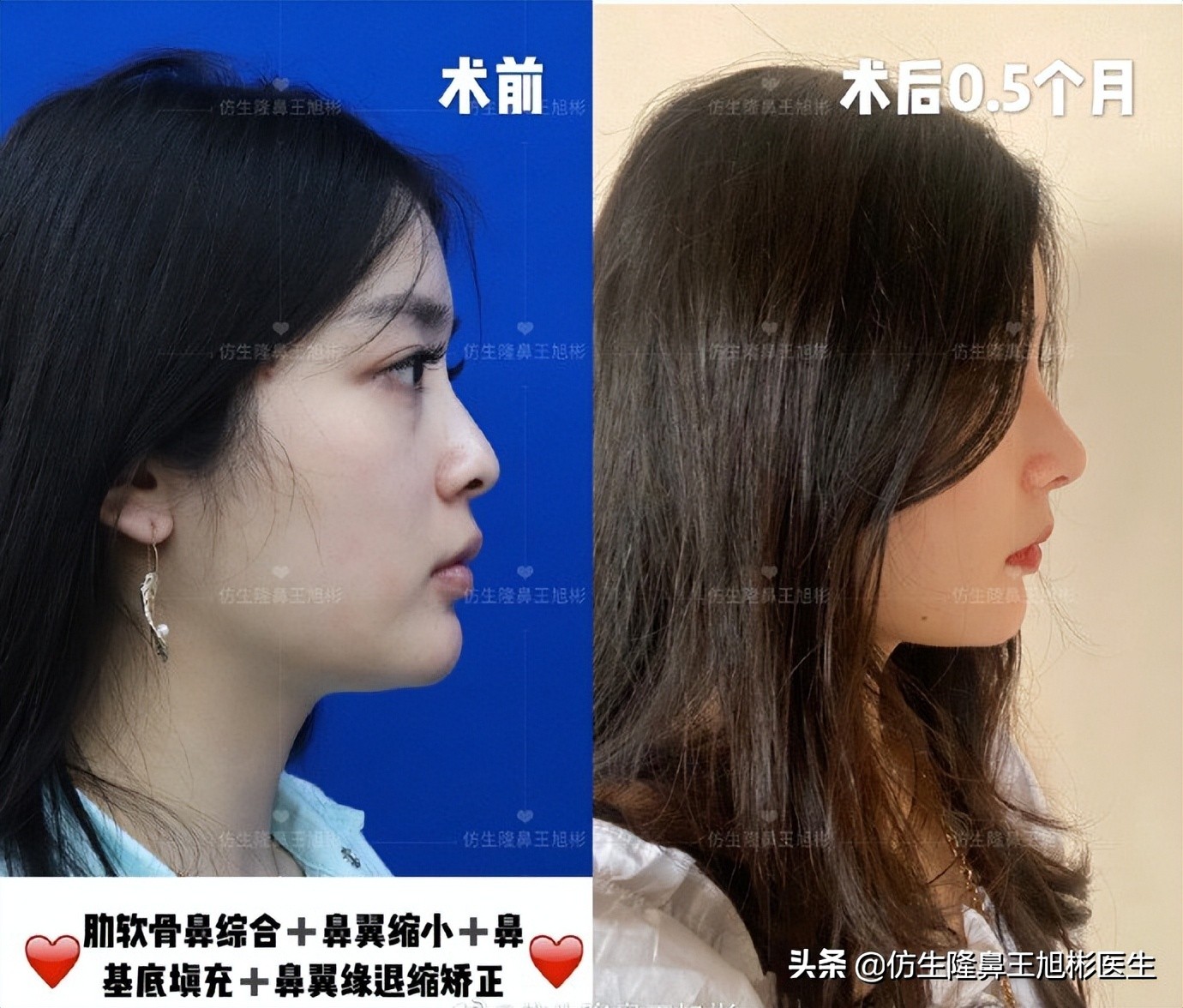 鼻头部位整形,鼻头圆钝高鼻梁整形案例