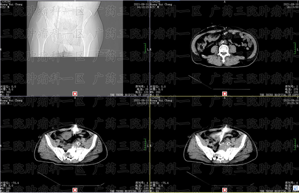 直肠占位病变是不是直肠癌？广药三院彭齐荣教授：不能这么认定