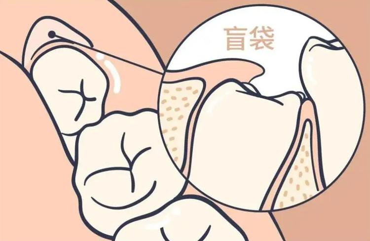 牙床有残根20多年了需要拔掉吗,牙只剩下残根了没法接需要拔掉吗