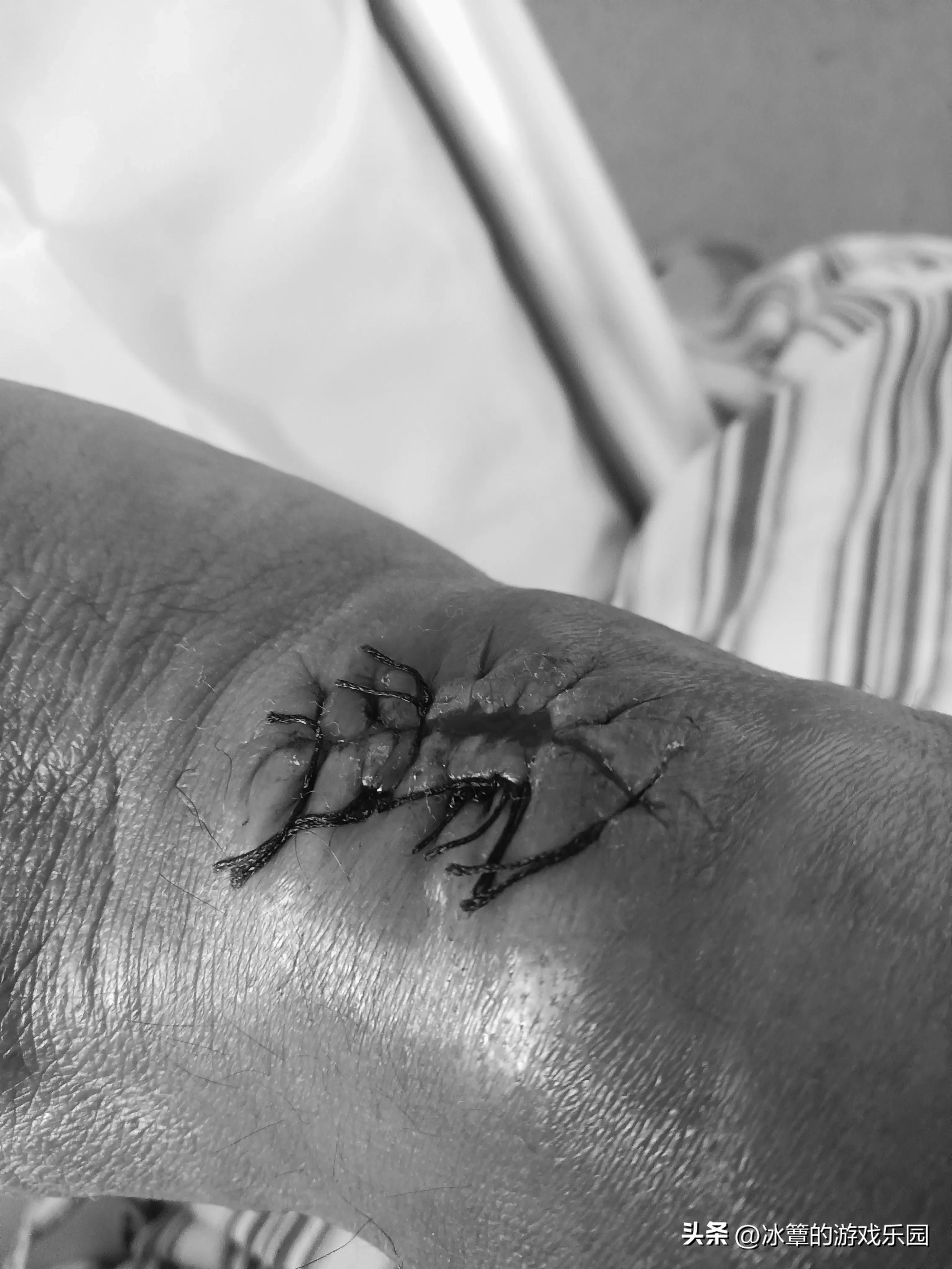 出院拔针,再次住院要相隔多少天才能报销