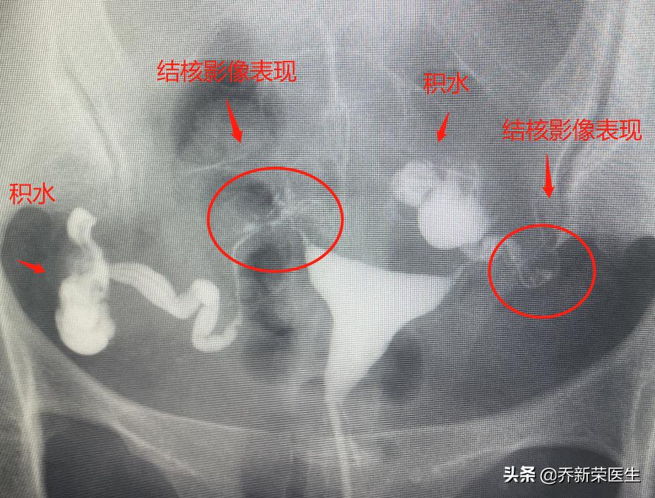 哪种造影可以查输卵管结核,怎么能确定输卵管有结核