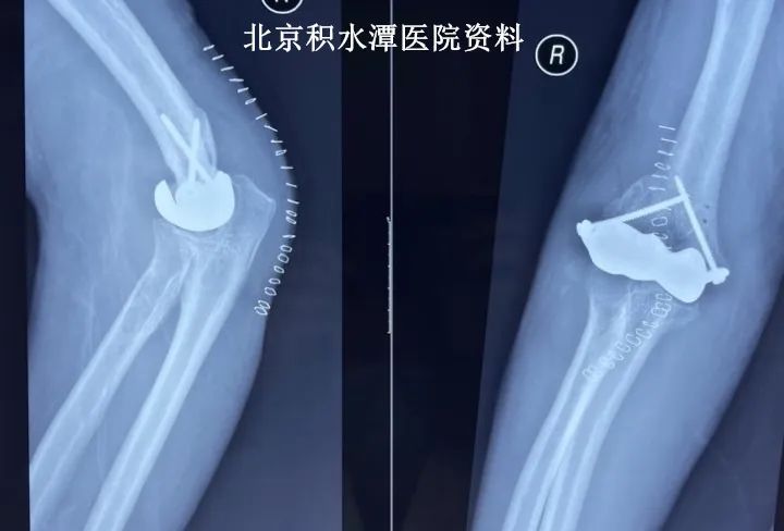 患者是我们最好的老师，也是我们创新的动力——北京积水潭医院蒋协远教授团队完成第二例肘关节表面置换手术